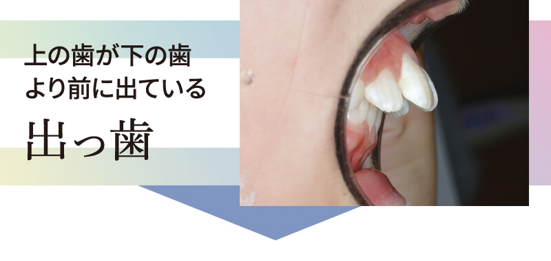 上の歯が下の歯より前に出ている 出っ歯
