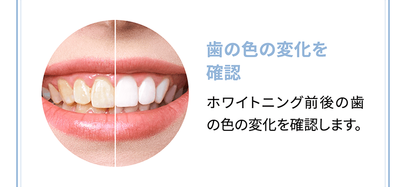 【歯の色の変化を確認】ホワイトニング前後の歯の色の変化を確認します。