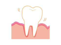 「歯根吸収（歯の根っこが短くなる）」が起こり、歯がグラグラしはじめるリスク