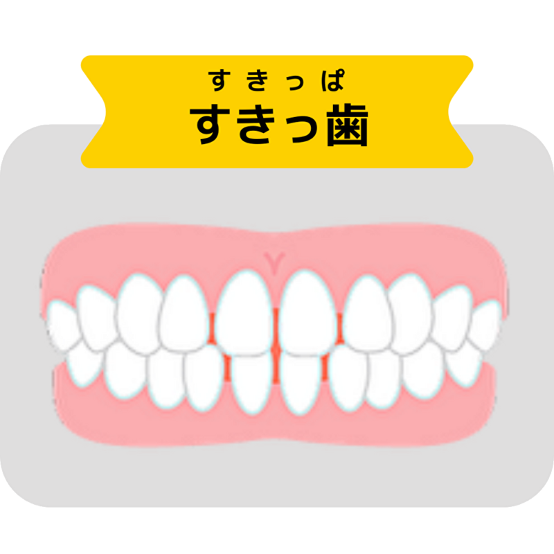 すきっ歯