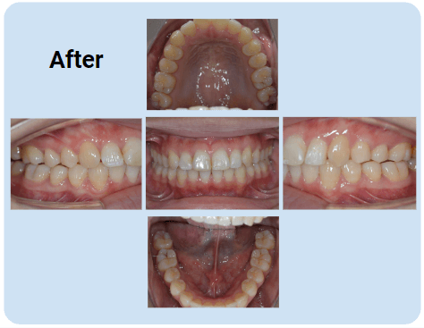 例1：ガタガタの歯並び（叢生）｜1年4ヶ月：After