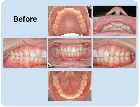 例1：ガタガタの歯並び（叢生）｜1年4ヶ月：befor