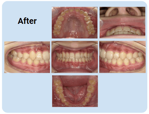 例2：ガタガタの歯並び（叢生）、交差咬合｜8ヶ月：After