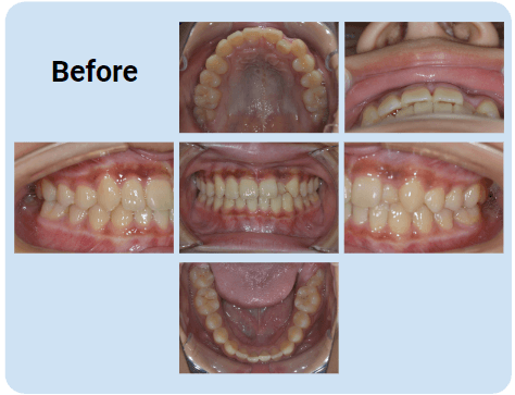 例2：ガタガタの歯並び（叢生）、交差咬合｜8ヶ月：before