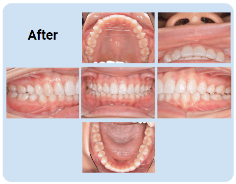 例3：すきっ歯｜4ヶ月：after
