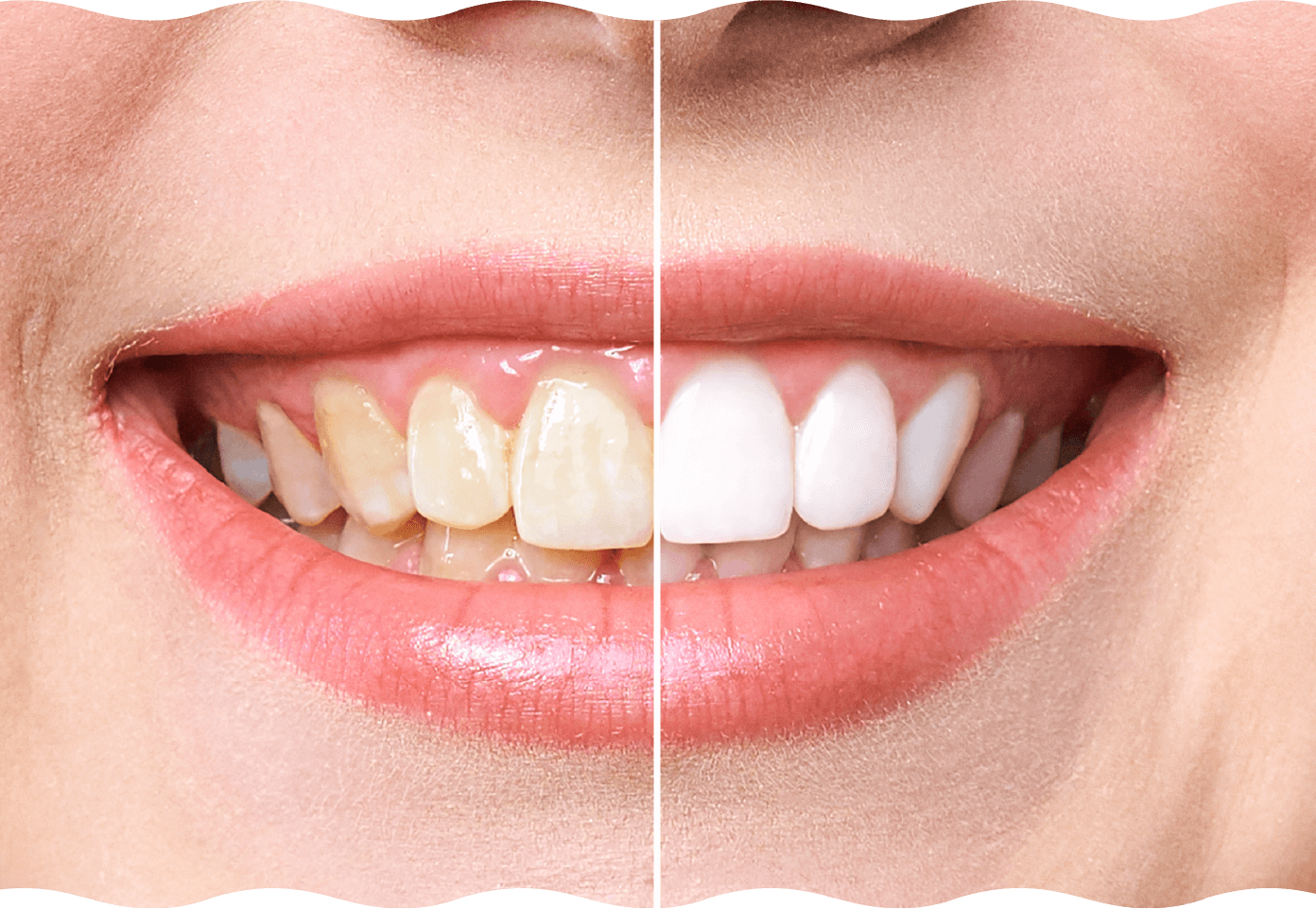 歯の色の変化を確認