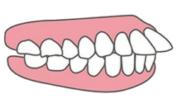 インビザラインGOができない症例は？出っ歯や口ゴボは治る？