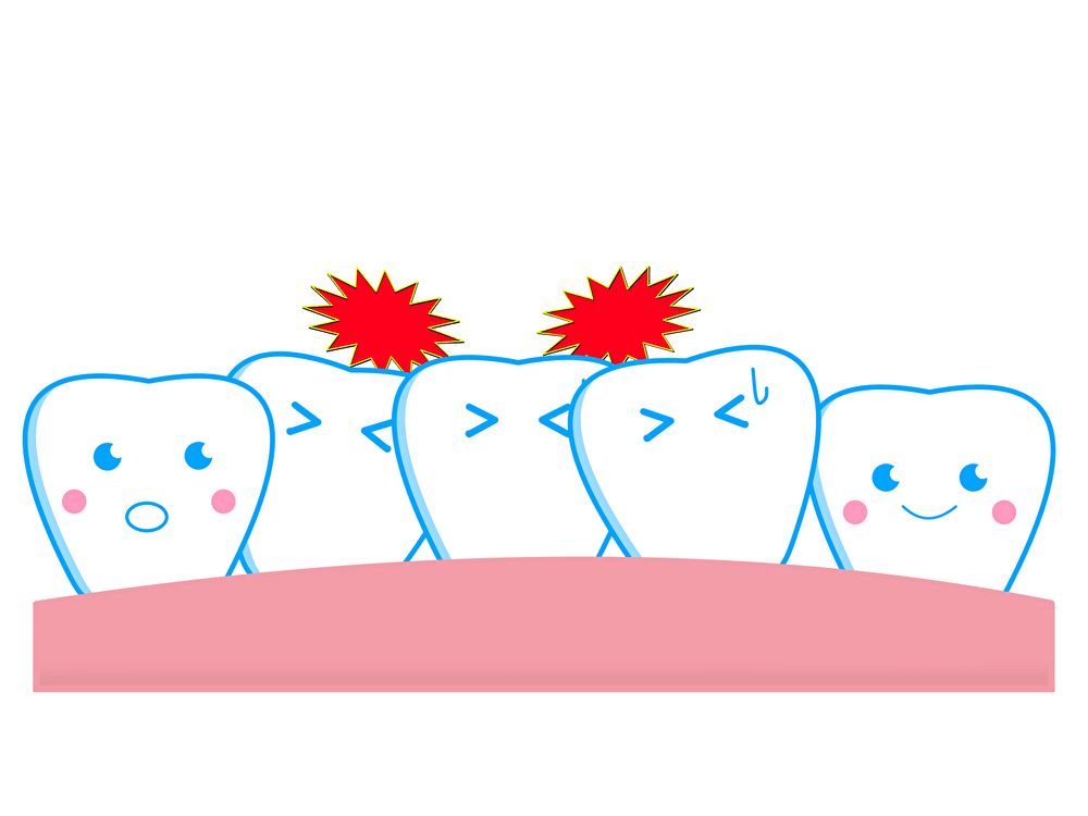 どうして歯並びが二列になる？『二重歯列』の原因とは