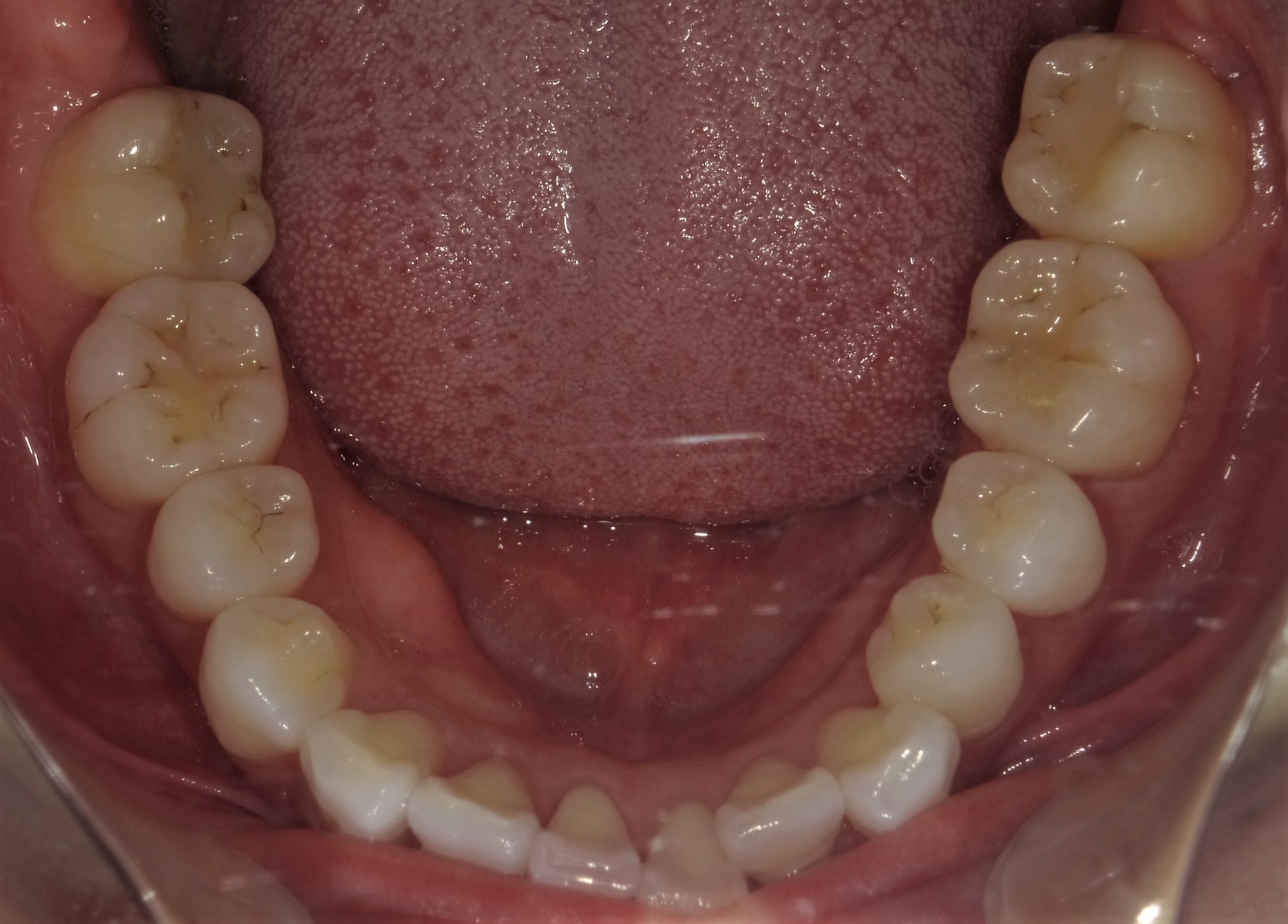 症例4治療前下顎